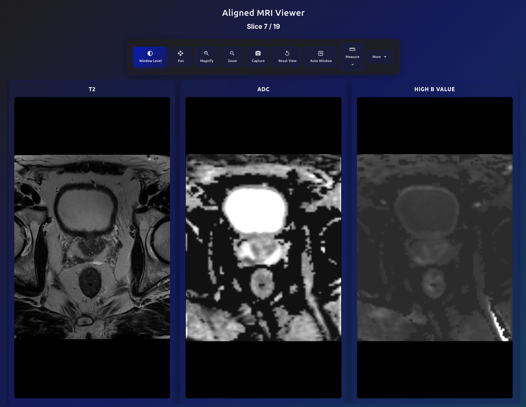 Aligned MRI viewer showing T2, ADC, and High B Value in same voxel space