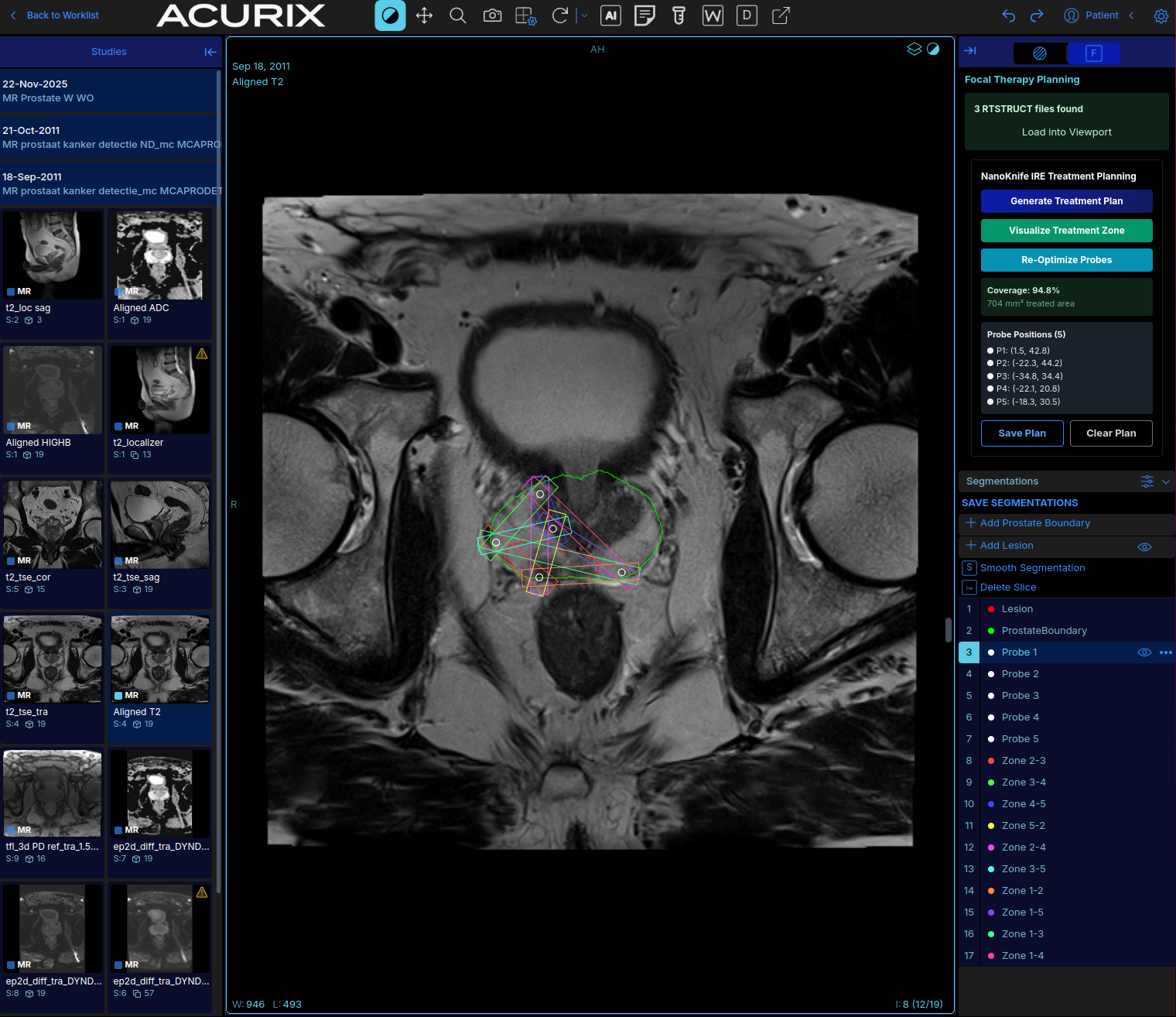 NanoKnife IRE focal therapy treatment planning with probe placement and treatment zones
