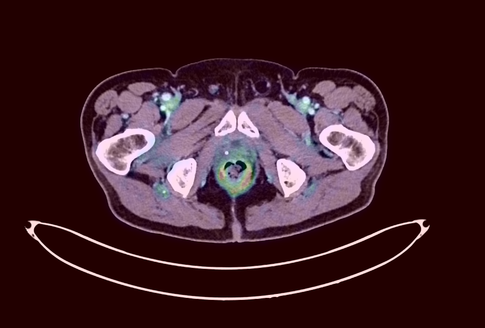 PET/CT fusion viewer with SUV measurement, colormap overlay, and MIP projection