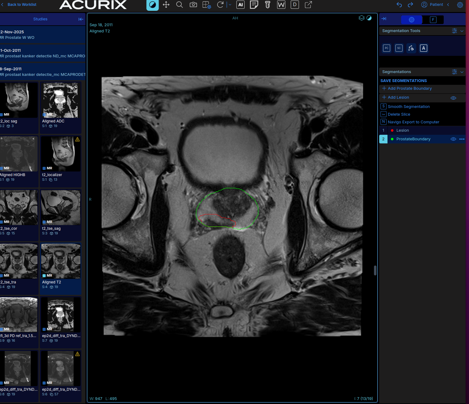 AI-generated prostate boundary and lesion segmentation contours